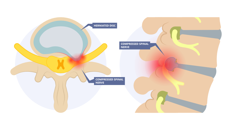 Condition of the Month: Sciatica
