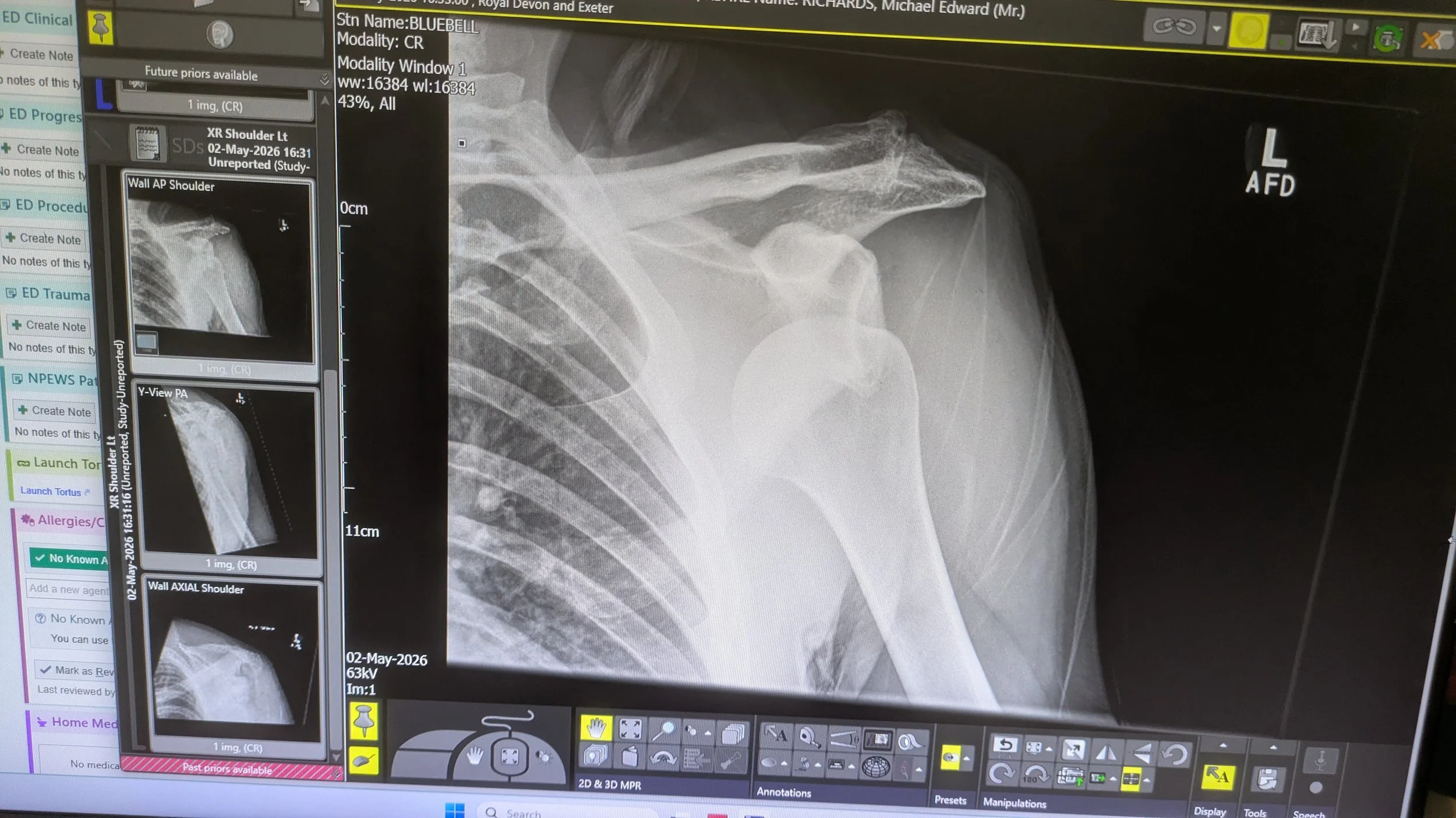 X ray image of a dislocated shoulder
