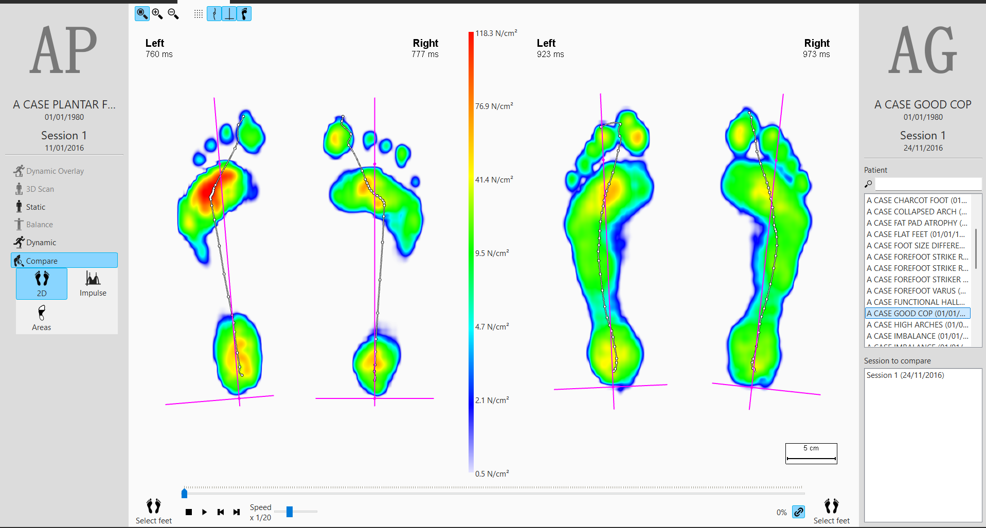 Our footscan software showing a plantar fasciitis patient (left) vs a normal gait (right).