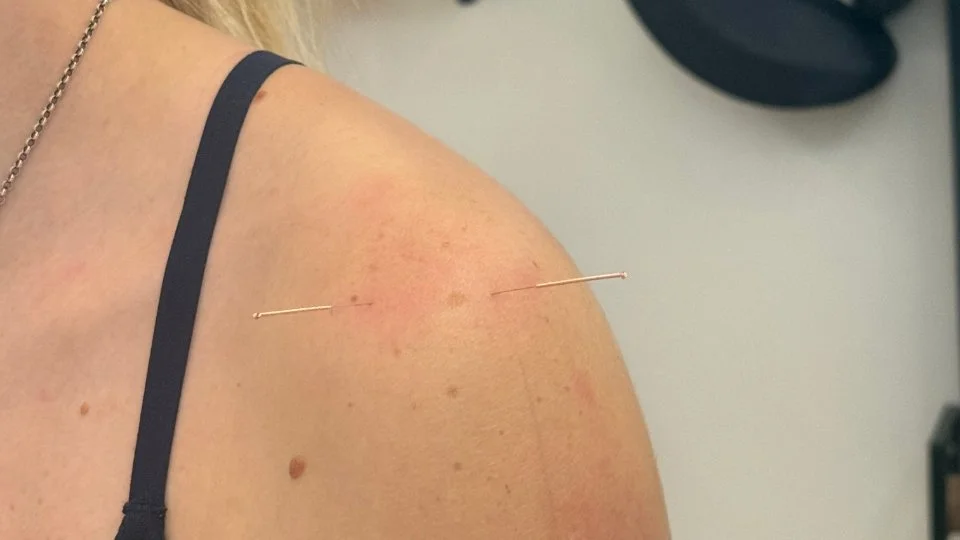 Acupuncture needles in a shoulder