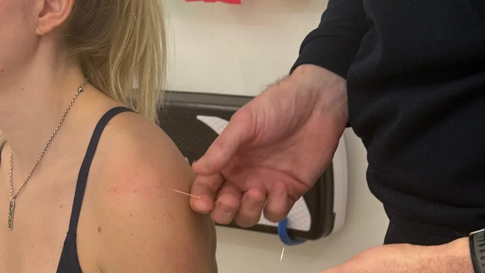 Acupuncture applied to a shoulder
