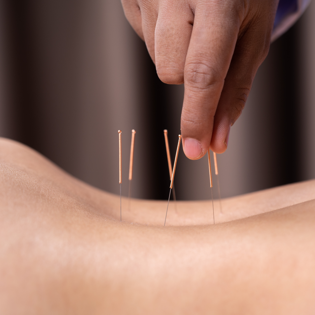A close-up of a person performing acupuncture, inserting thin needles into someone's skin on their back.