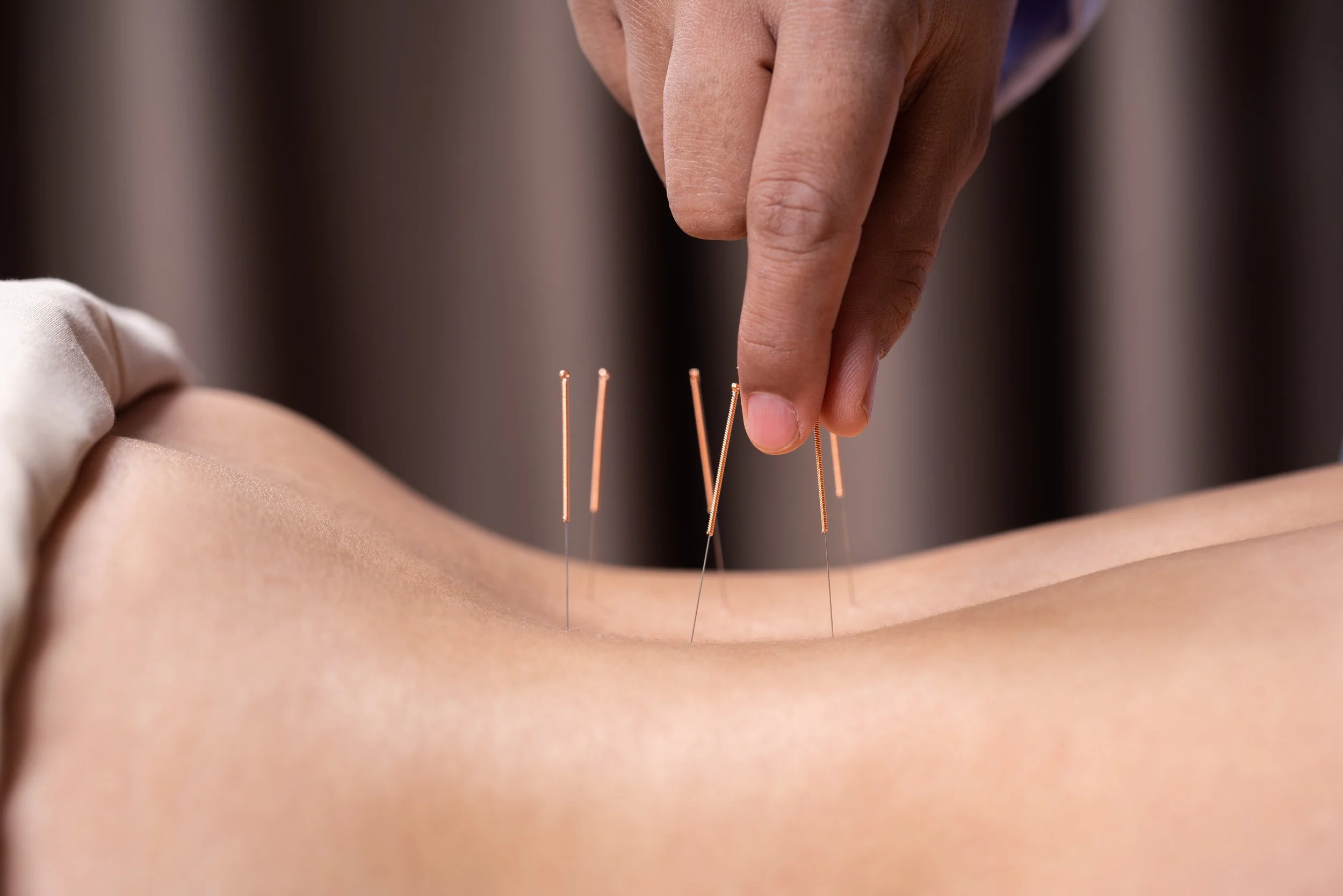 Acupuncture applied to the lower back