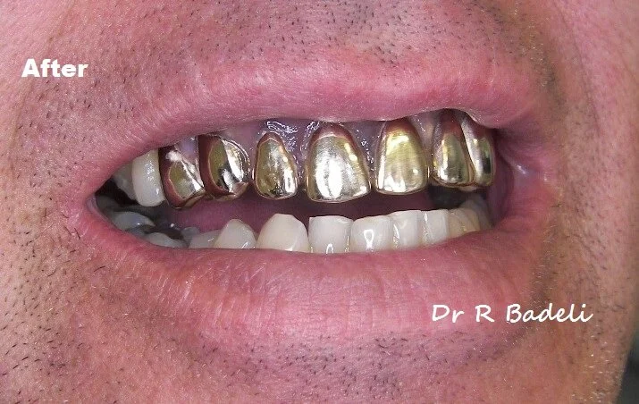 Gold Tooth Gold Tooth Cap Gold Crown Tooth Gold Teeth Caps Gold Tooth Gold Tooth Cap Gold Crown Tooth Gold Teeth Caps