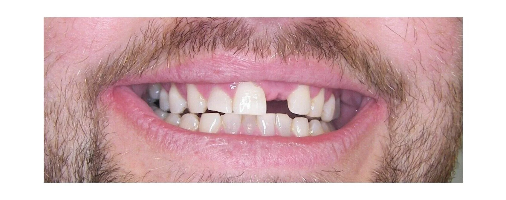  Maryland resin bonded bridge dental bridge front teeth private