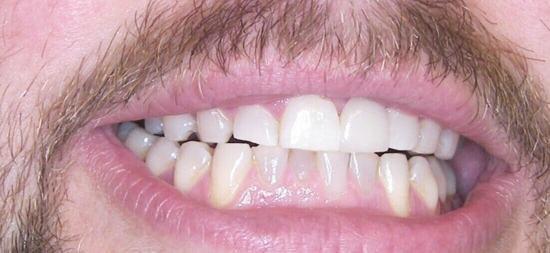  Maryland resin bonded bridge dental bridge front teeth private dentist Chester, Cheshire