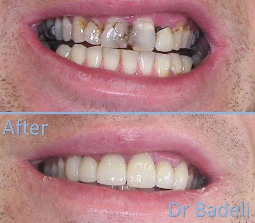 Smile Gallery Pictures of dental crowns before and after Dental
