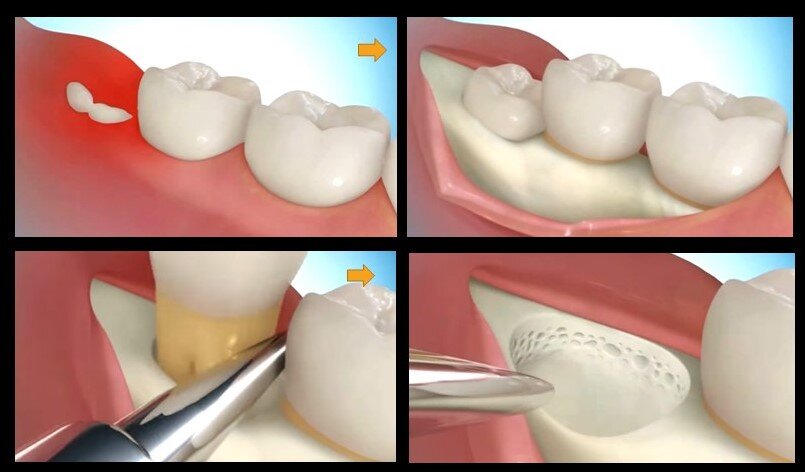 Wisdom tooth surgery extraction