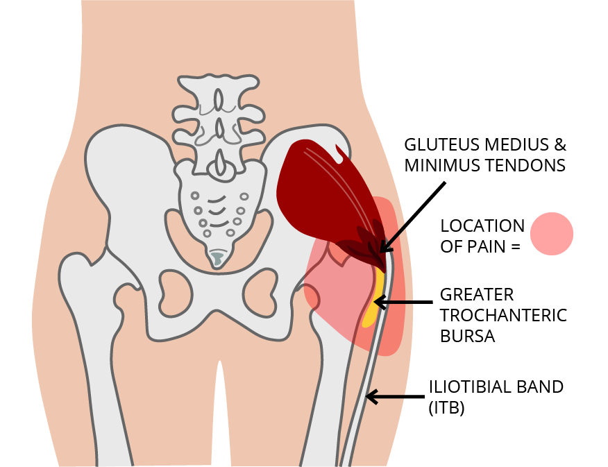 Gluteus Medius Syndrome and Hip Pain 