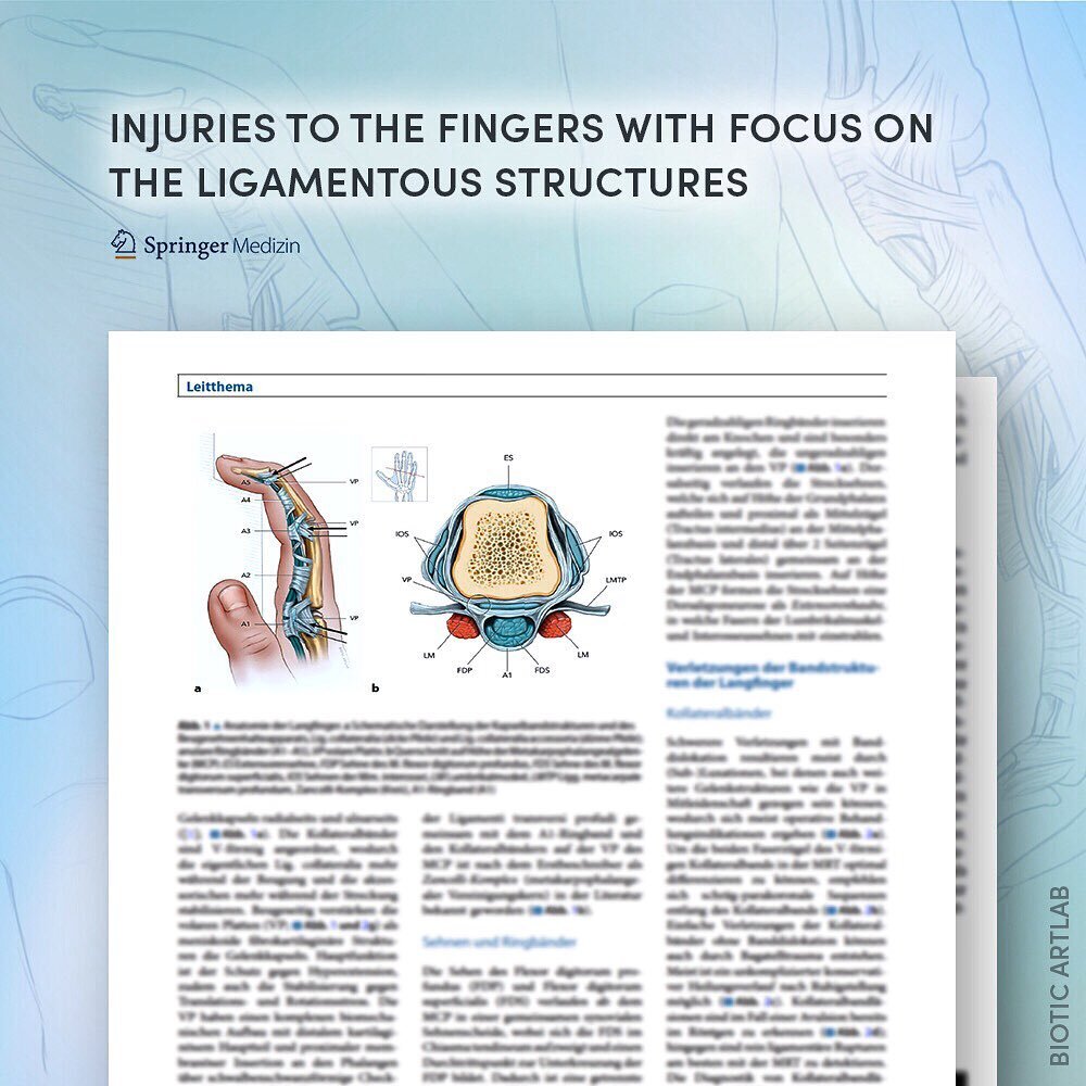 Excited to share that our work on finger pathologies in rock climbing has been published in Der Radiologie, which focuses on diagnostic and interventional radiology, radio-oncology, and nuclear medicine. We teamed up with an orthopedic surgeon 👨&zwj