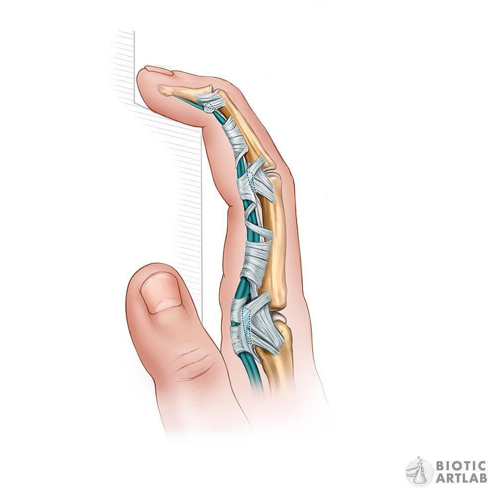 We wanted to share our latest work for our orthopedic surgery client. These illustrations show the anatomy of the finger👆🏻

Our pulleys and ligaments are crucial for keeping the flexor tendons close to the bone. When climbing 🧗🏻&zwj;♀️ immense fo