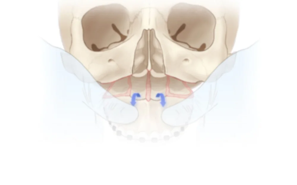 Maxillary Osteotomy Medical Illustrations — Biotic Artlab