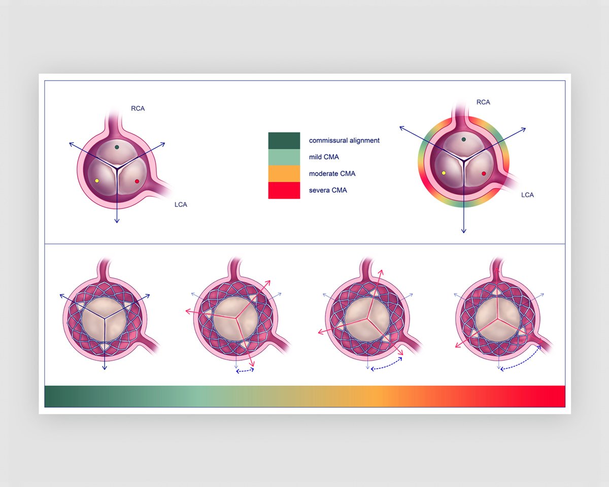 Medical illustration medical figure TAVR transcatheter aortic valve replacement coronal ostial eccentricity research article | By Biotic Artlab