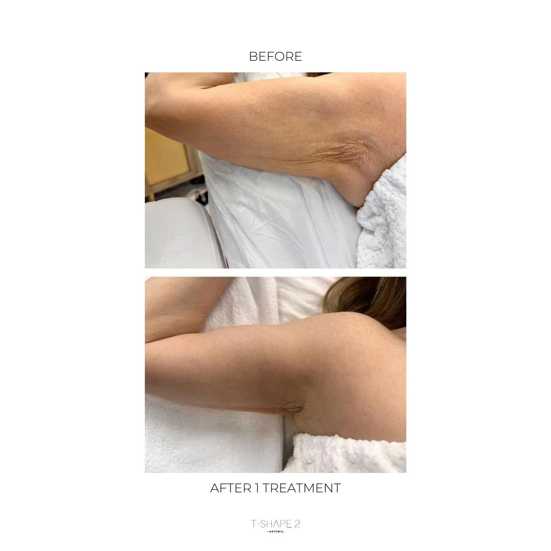 B&A_1 TREATMENT_ARMS.jpg