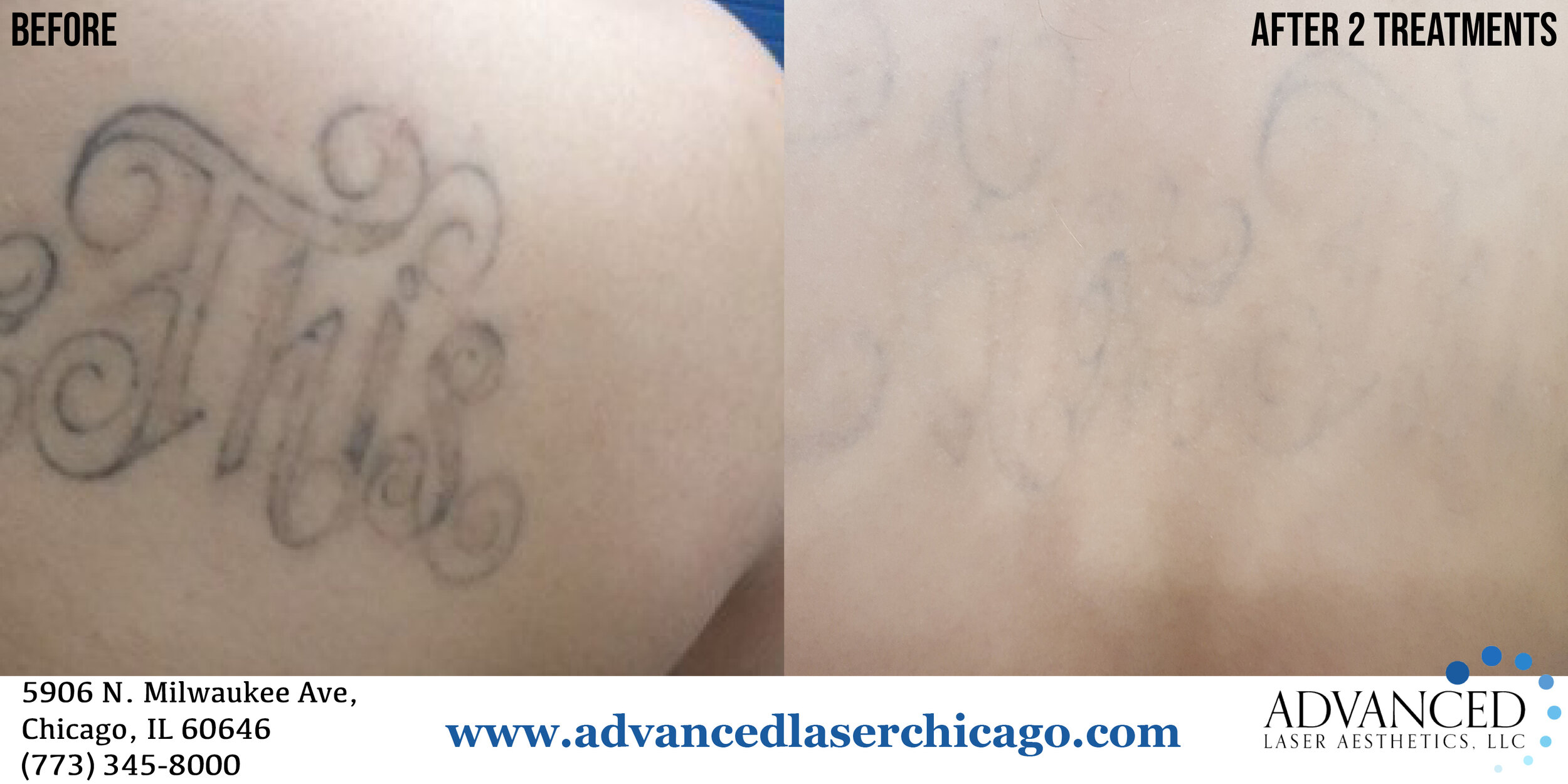 Tattoo Removal  Reset Medspa Chicago IL