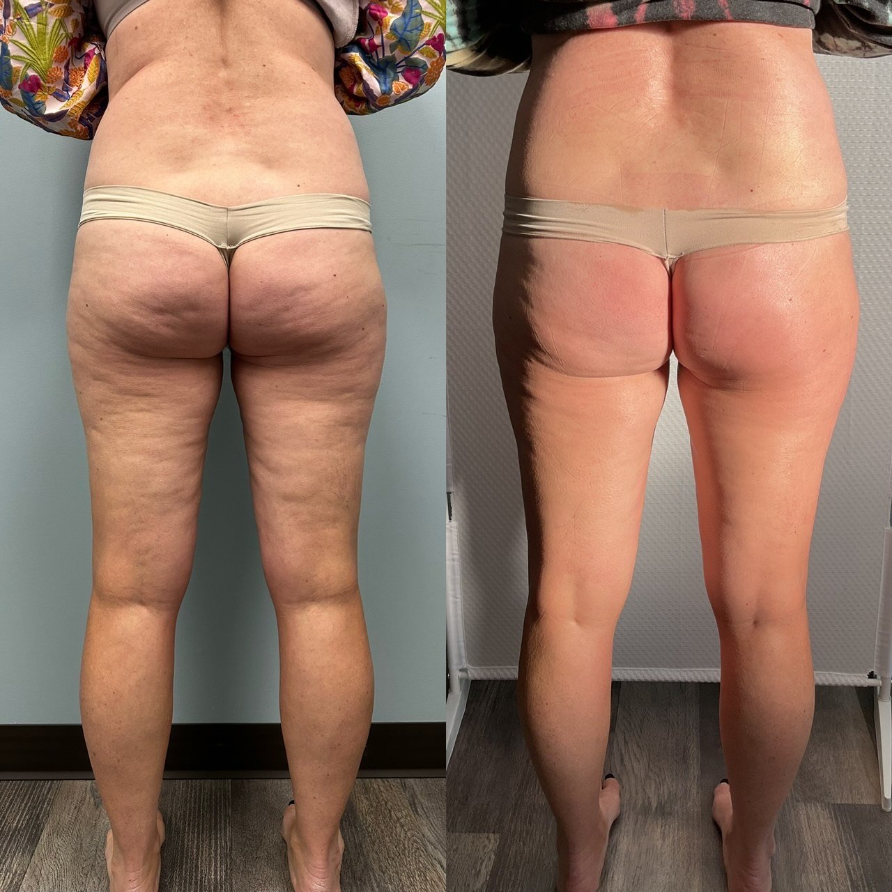 After 3 treatments (back).jpeg