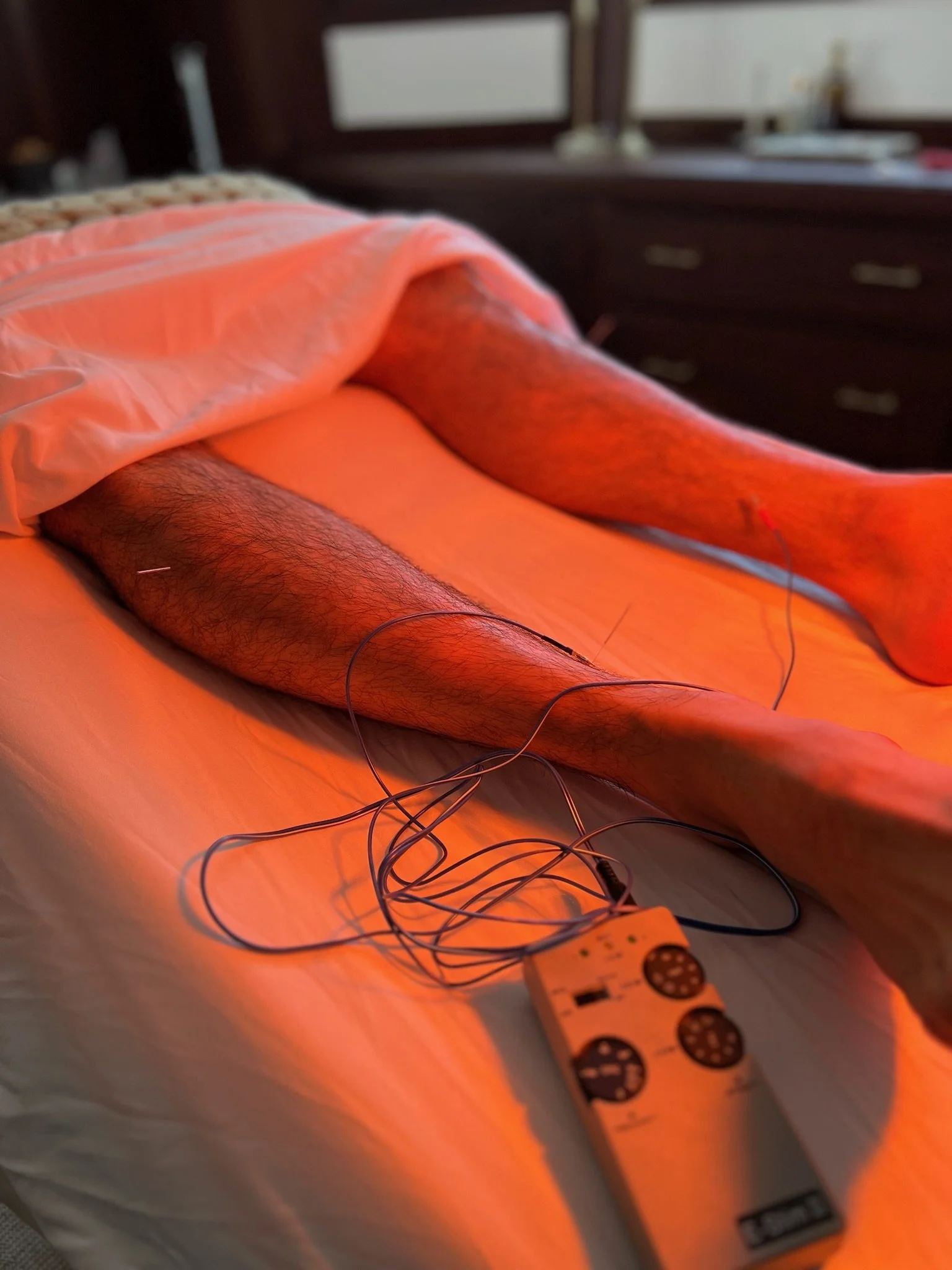 Acupuncture &amp; Type 2 Diabetes 