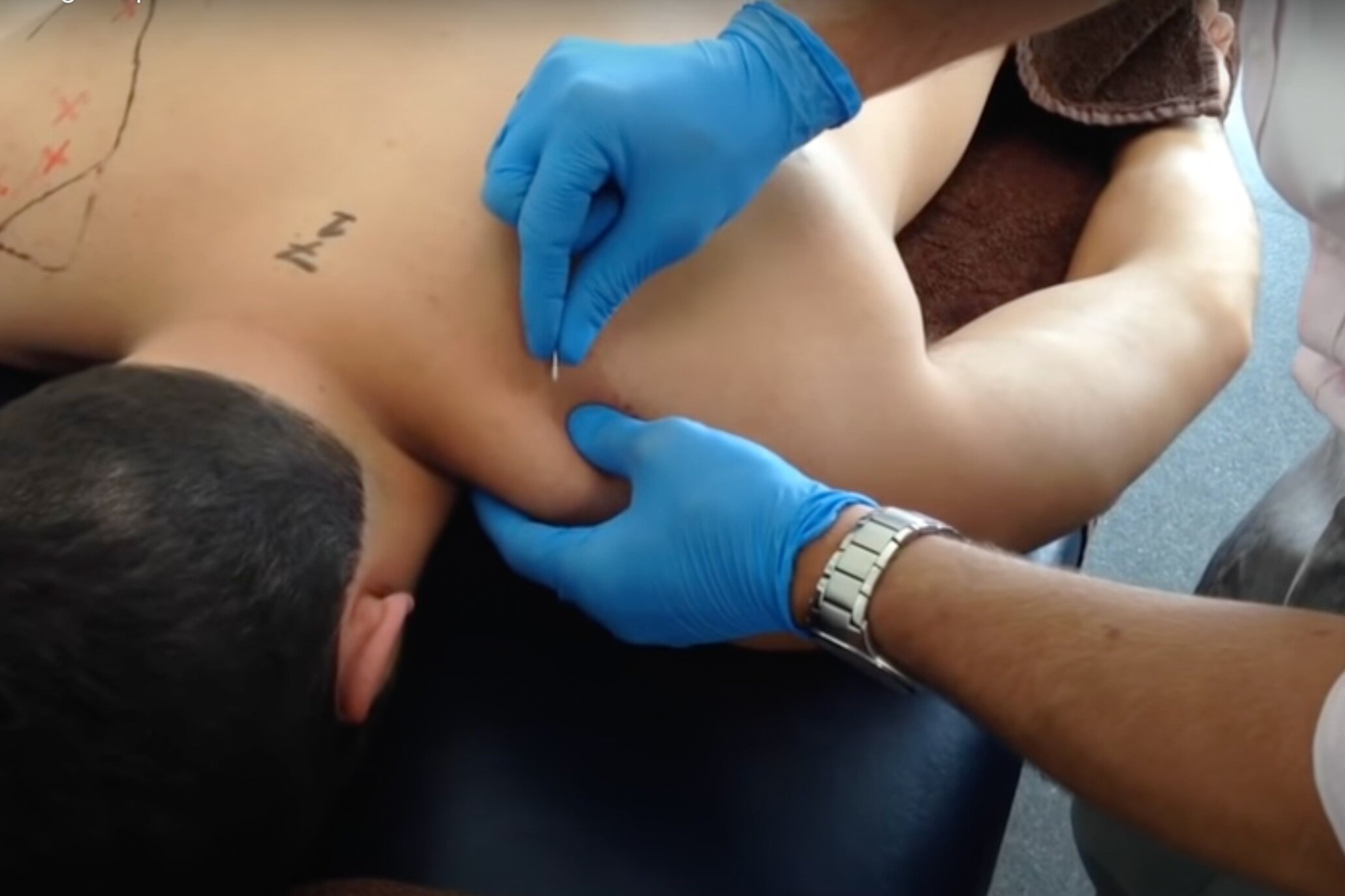 Electro Dry Needling – EP Bodywork Therapy