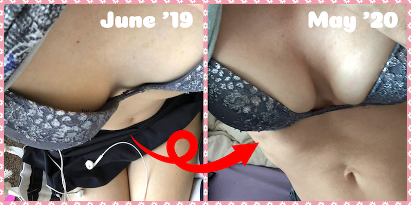 Natural Breast Enlargement Success Story in the 30s with Before and After  Photos #4 — Give Me Some Boobs!