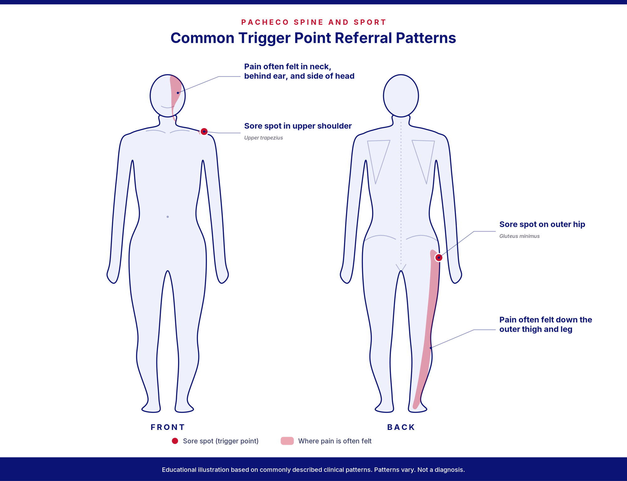 Diagram of trigger point referral patterns from the upper shoulder to the head and from the outer hip down the leg