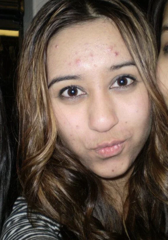 In 2015 at 18 years old, when my cystic acne was it’s peak (and when I thought making a duck face was cool…). This was right before I was put on birth control to balance my hormones.