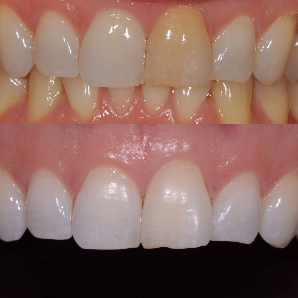 What is Internal Bleaching for Teeth and When Do I Need It? — Downtown Dentist SF