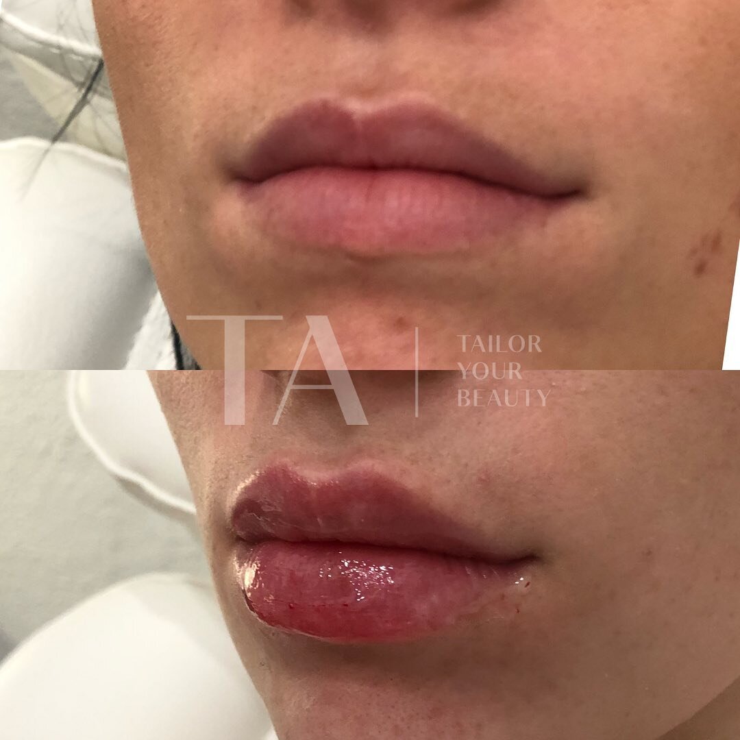 And sometimes a full pout is exactly what we are going for&hellip;. 💋

During your appointment we will always have a discussion for what your ideal outcome is vs reality. ☝🏻

This specific patient has the natural lip shape and facial features to ho