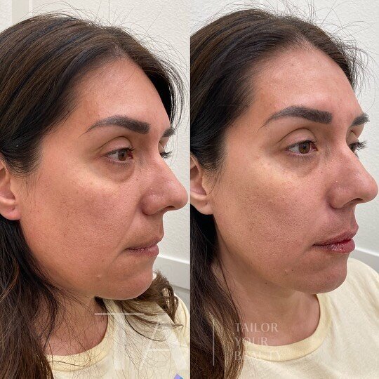 &ldquo;I don&rsquo;t want to look tired anymore&rdquo;. 🥱

This is a statement I often hear often in the office, as it&rsquo;s frustrating to feel full of energy, but not feel your appearance reflects that. 

For this beautiful woman we placed 5 syr