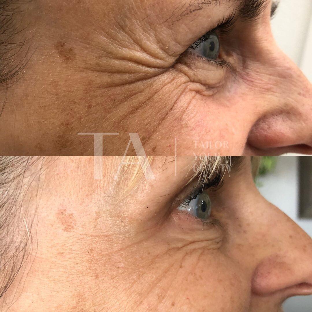 When a first time Botox patient&rsquo;s results kick in&hellip; it&rsquo;s a magical moment! ✨

We wanted to enhance this beauty&rsquo;s contagious smile by softening the lines around her eyes. 💕

Remember: when you&rsquo;re new to Botox, each time 