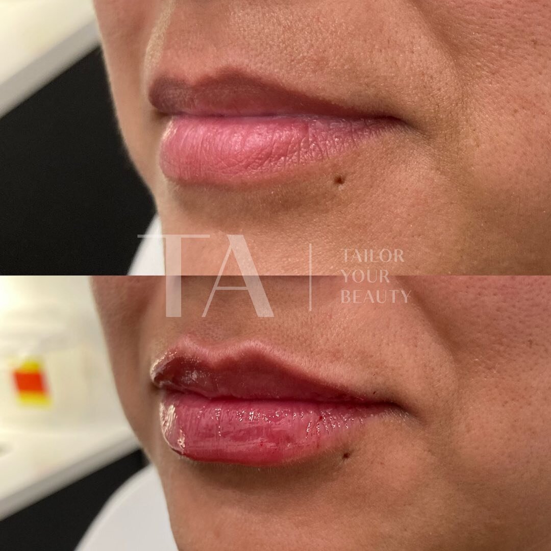 Even ladies who are blessed with full lips, want want little definition and plump. 👌🏻
As we age, collagen and elastin break down in our lips too, and begin to show in a change of texture and loss of volume. Lips don&rsquo;t always have to be about 
