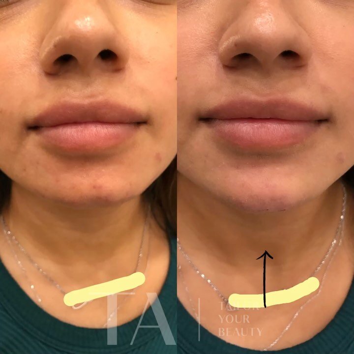 When you come in for lips, and leave with a tapered chin ✨

It&rsquo;s common to think you need lip volume, when you really could just use some facial balancing. Chins are a sneaky way to make a big impact. 👊🏻💥

My choice for chin filler is Juvede