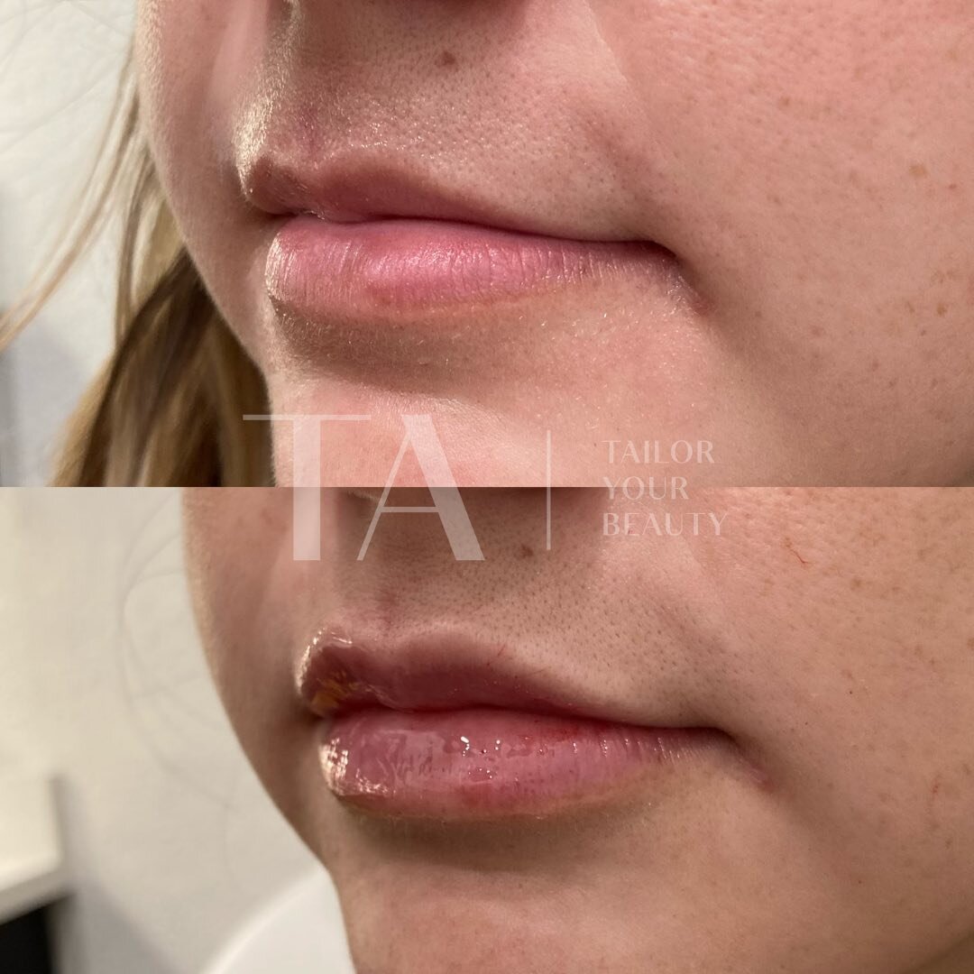➡️ Swipe to see which areas we softened when she came in for lips! 💋

⚠️I will give unsolicited advice when it comes to working on facial balance and harmony! 
And that&rsquo;s because I want you to age NATURALLY too! Enhancing not distracting! 💕

