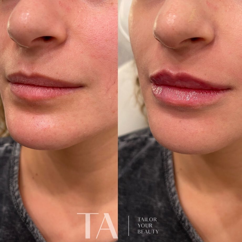 As always, your lips &mdash; but better 🤍

Booking now for Jan 2024, DM to get on waitlist. ⚡️

#lipfiller #bayarealips #lipbeforeandafter #209botox #209lips