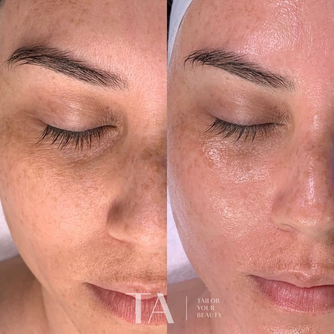 ✨Before &amp; After a Deluxe Hydrafacial ✨

Keep your skin maintenance up with  monthly HF treatments with our membership options! 

#hydrafacial #getglowing #skincoaching #HF