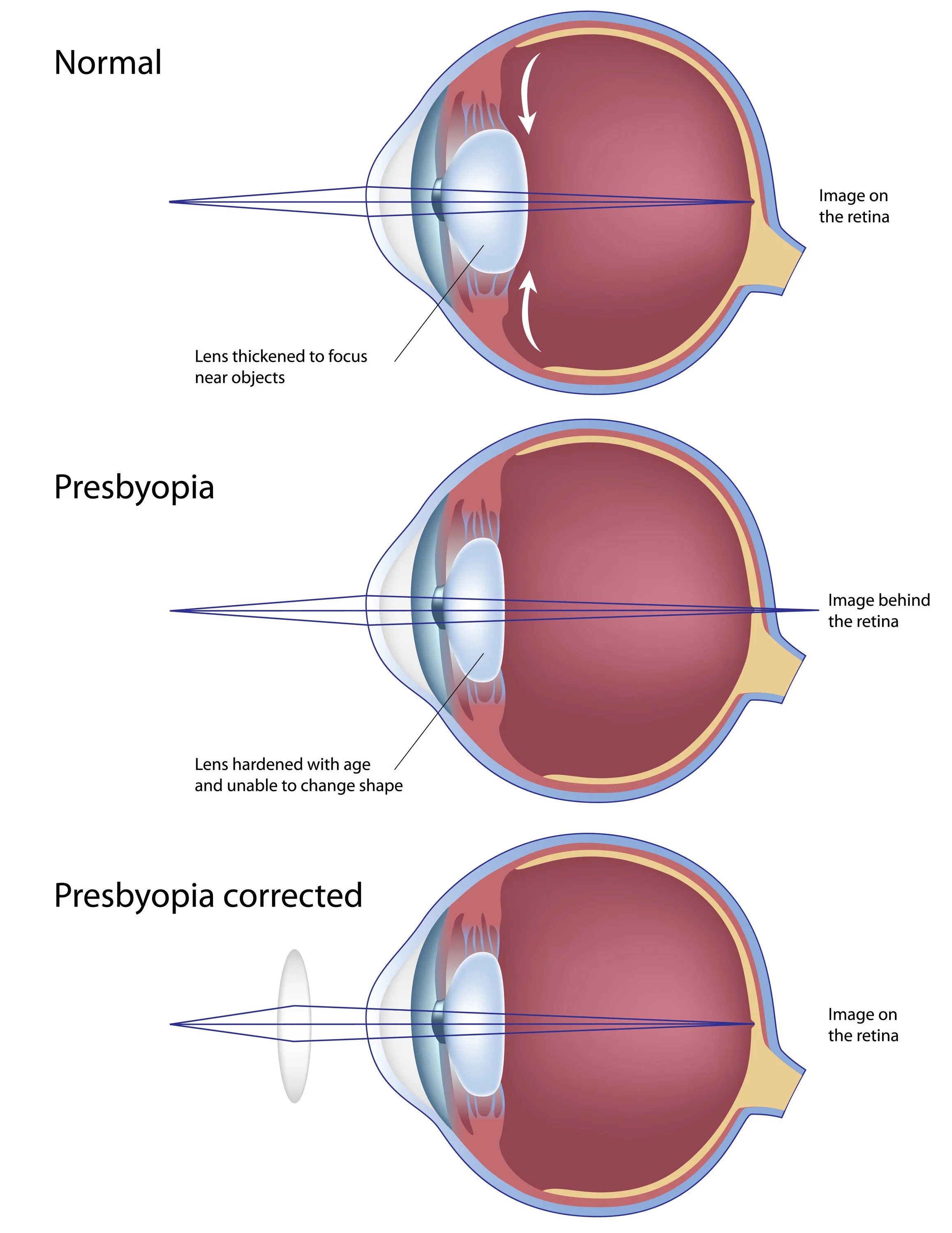 Presbyopia | Enhance Your Focus — Wynne Eye Associates