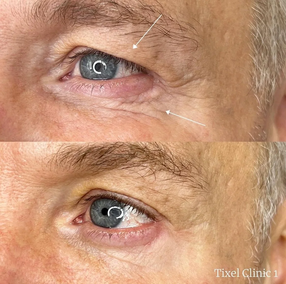 There you go, amazing results after 3 Tixel sessions for eyes 😍 Tixel is very effective and safe to treat lines and wrinkles in delicate eye area.

Tixel uses pure heat with no laser light or needles. Less downtime and discomfort than more aggressiv