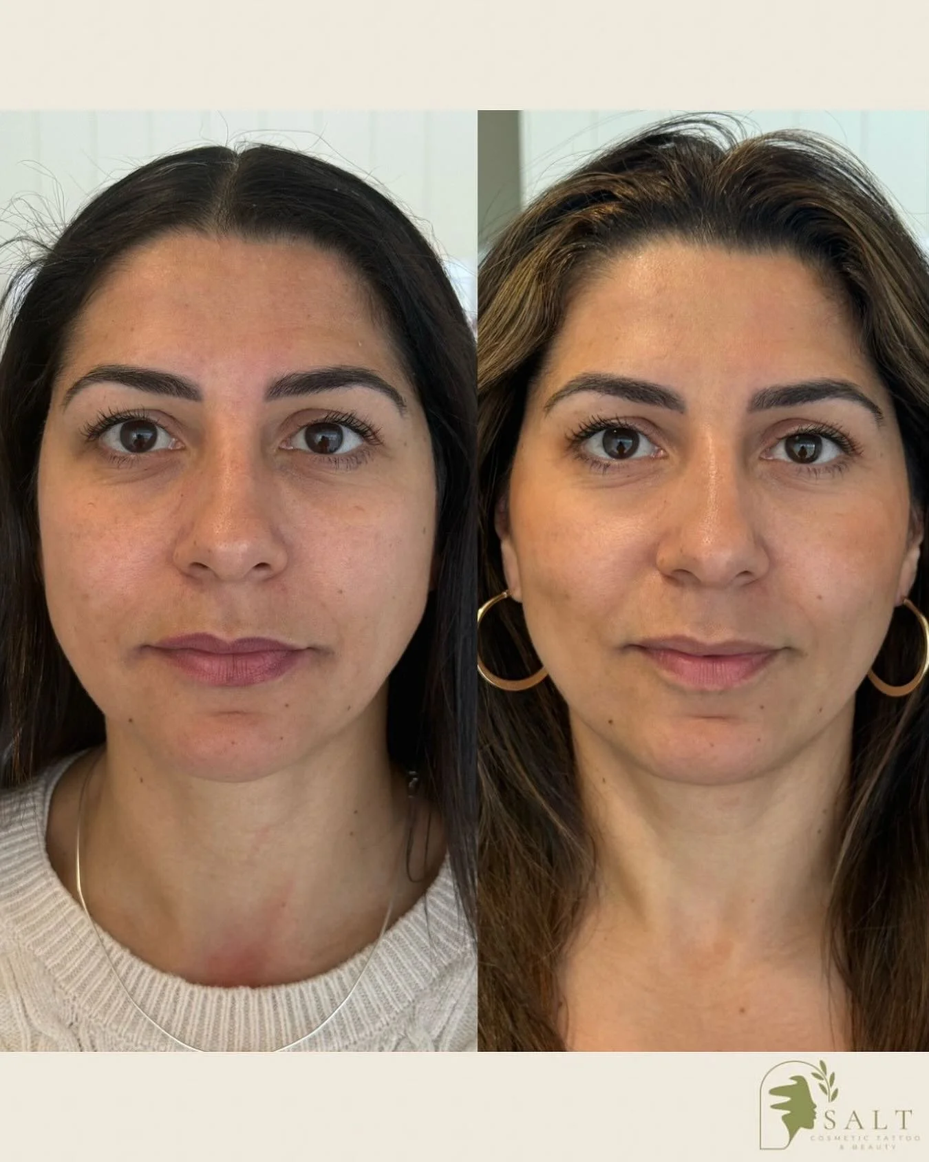 ✨ We love Tixel! ✨

This client hasn&rsquo;t had cheek or mid-face filler &mdash; her facial composition has transformed after just two rounds of Tixel. Notice how her face is no longer heavy in the lower half? That&rsquo;s because collagen and elast
