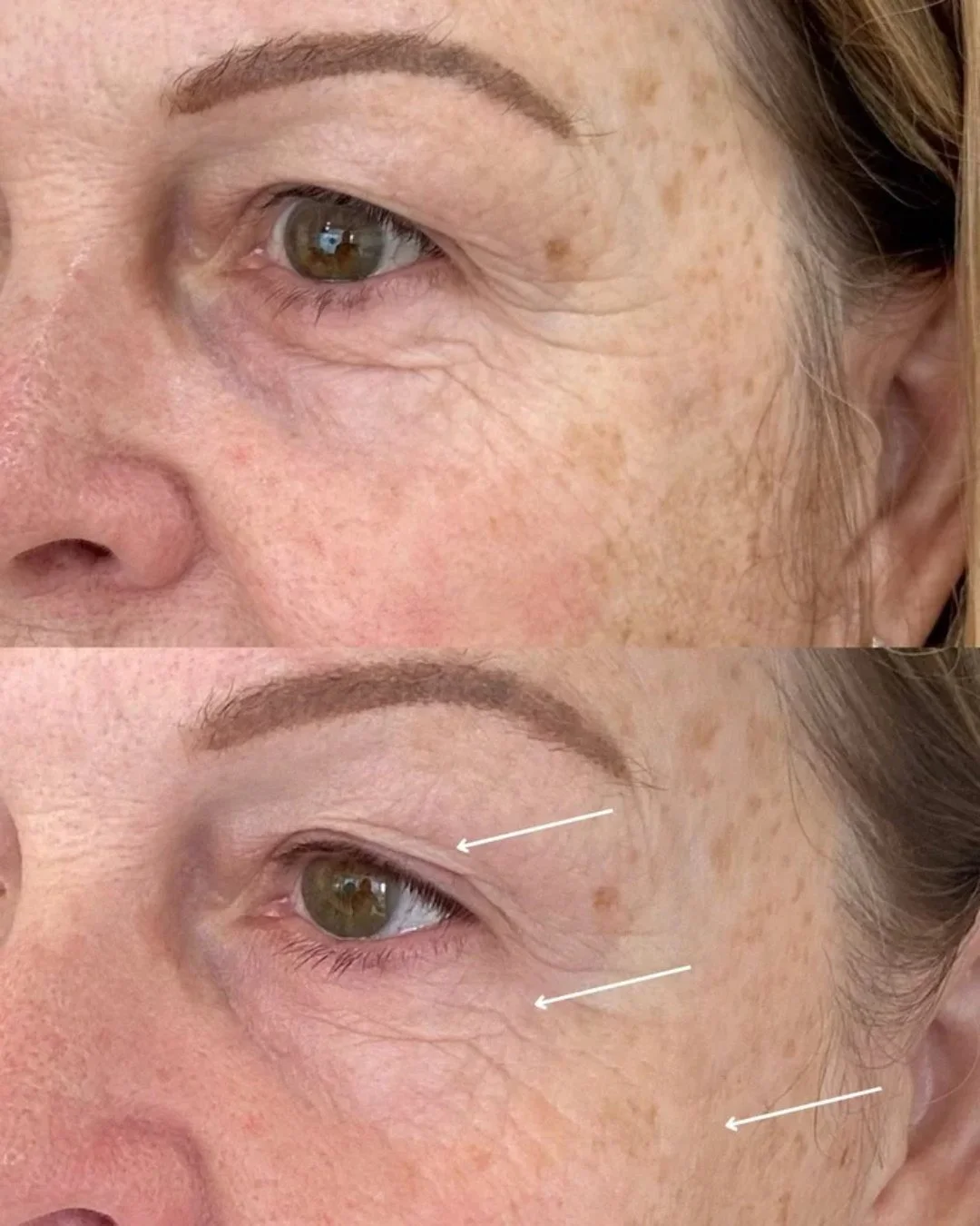We&rsquo;re still in awe of the incredible skin transformations achieved with Tixel treatments. 

Tixel is changing the way we rejuvenate skin✨
It firms, smooths, and brightens even treating the delicate under-eye area safely right to the lash line. 