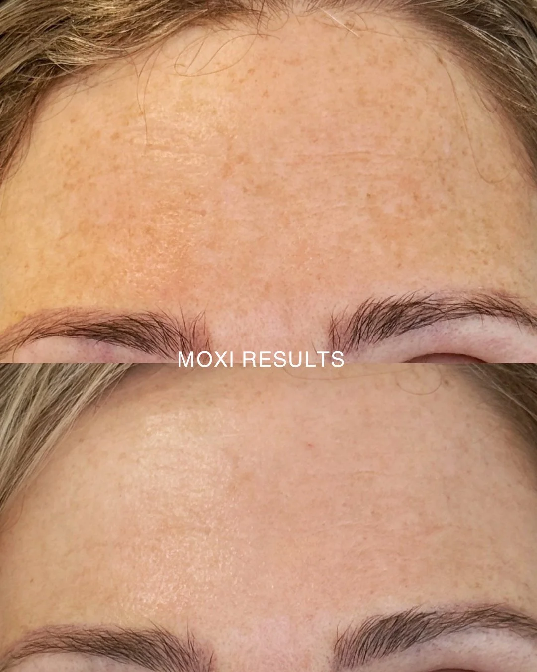 Check out this incredible before and after results of Moxi!

Whether you're new to laser treatments or looking to maintain results, this gentle yet effective technology helps your skin stay ahead of the curve.

.
.
.
#moxi #moxilaser #skinclinicballi