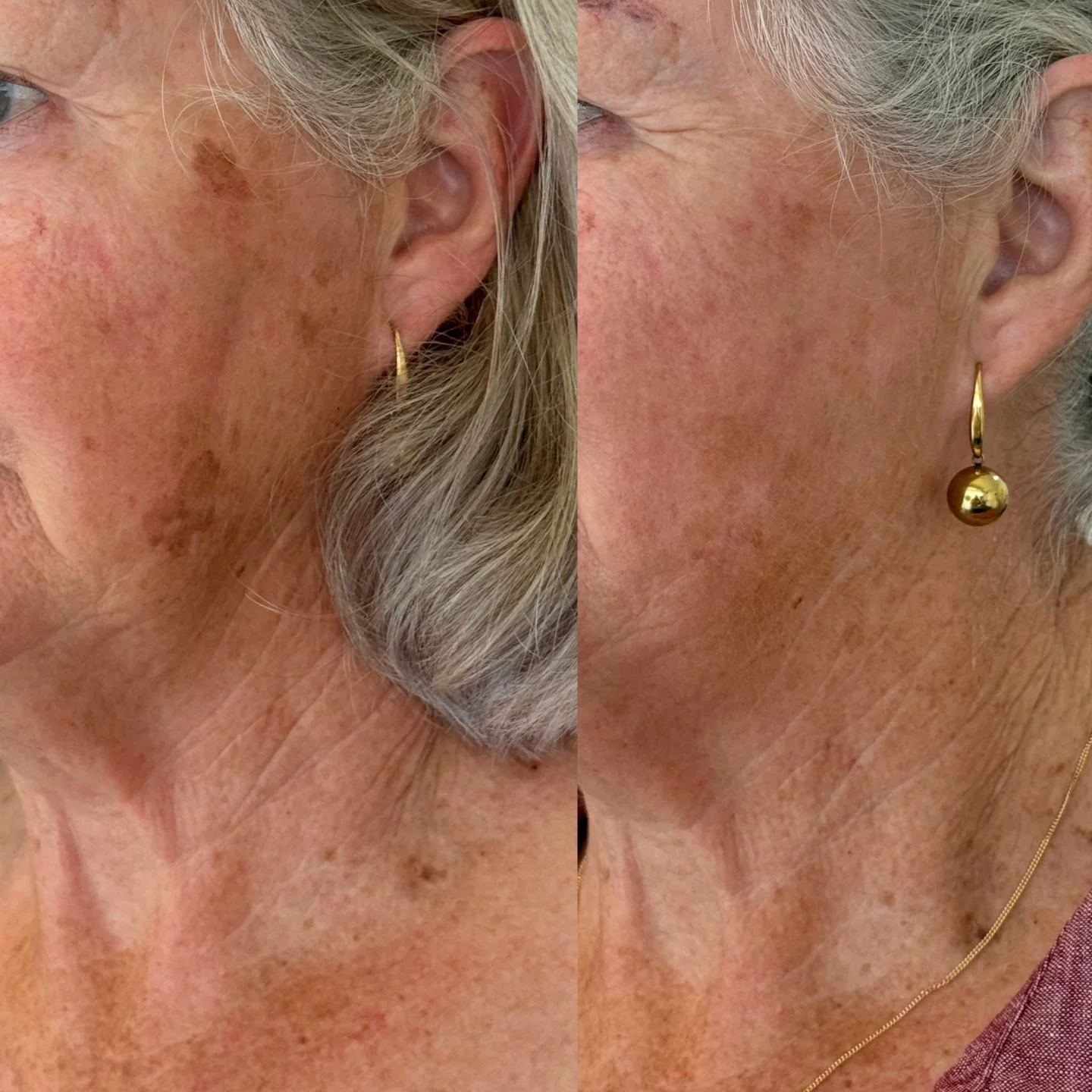 Results after just one BBL Hero treatment to minimise unwanted pigmentation 🤍

BBL Hero doesn&rsquo;t just target sun damage and uneven tone &mdash; it works at a cellular level to support skin rejuvenation.

Studies show BroadBand Light treatments 