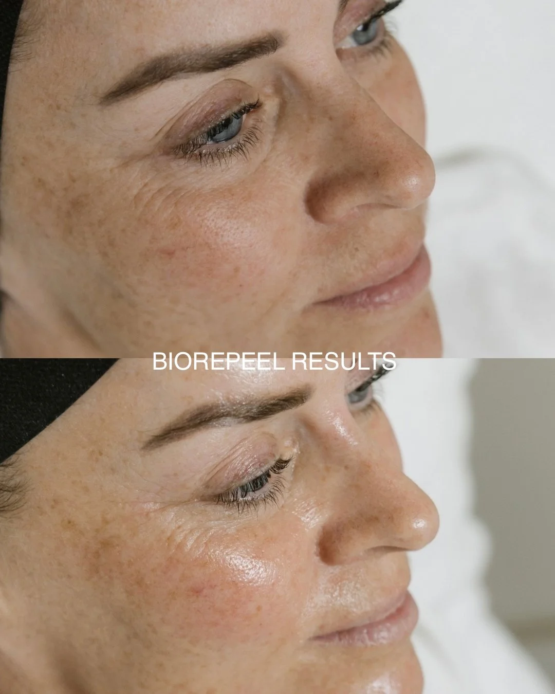 This is after only ONE BioRePeel And the results speak for themselves!!

Instant glow and clearer, brighter skin 😍 a Peel you can get on your lunch break 💁🏻&zwj;♀️

Book your appointment today 📲

.
.
.
#saltbeauty #ballinaskinclinic #ballinabeaut