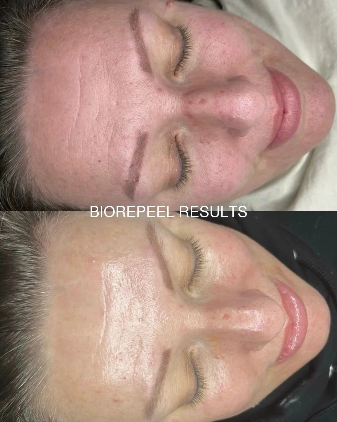 The magic of Biorepeel 🪄 

Our BioRePeel treatment brightens dull skin with powerful active ingredients that work beneath the surface - removing dead cells, stimulating collagen and elastin, and promoting cell turnover.

The result? Smoother texture