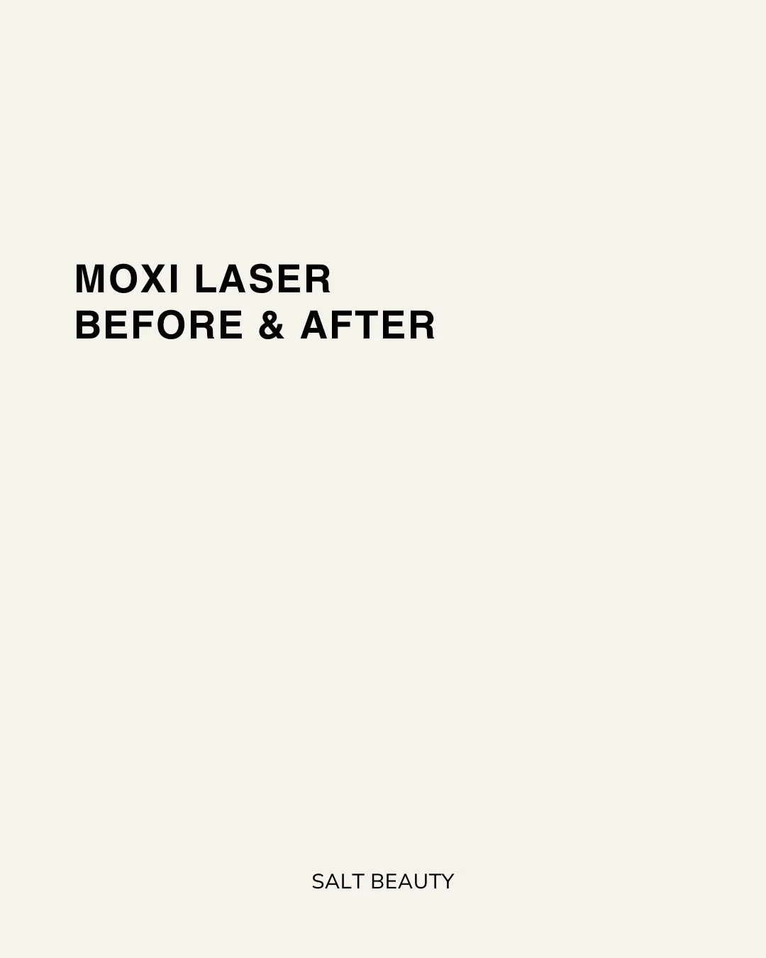 MOXI Laser is a PROVEN and effective treatment for various skin concerns.

MOXI is a gentle, non-ablative, fractionated laser suitable for ALL skin types YEAR-ROUND.

MOXI treats:
- Signs of Aging
- Sun Damage
- Discoloration
- Uneven Skintone
- Acti