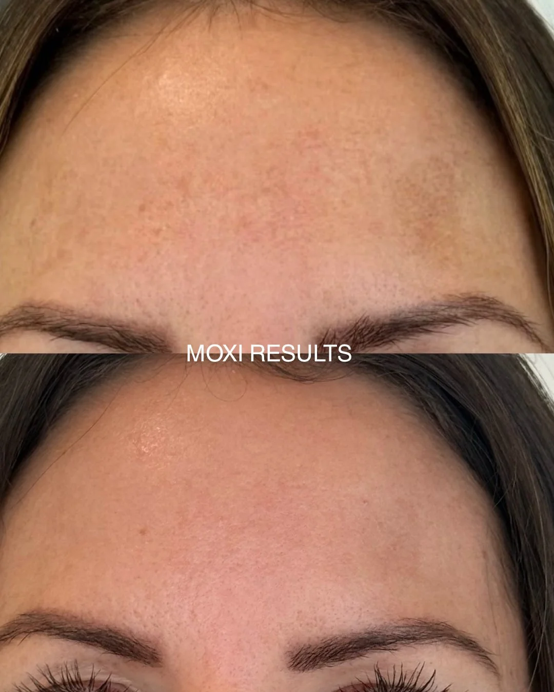 MOXI for Melasma Results✨

Before and After ONE Moxi treatment

Melasma is a common form of pigmentation caused by hormones, heat, and sun exposure-and it can be very stubborn. It's not just "sun spots," which is why treating it correctly m