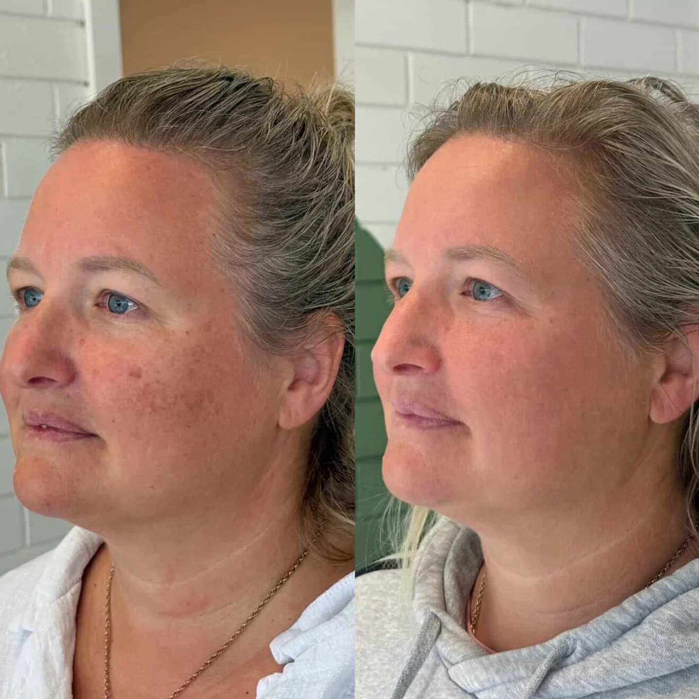 Do you have sun damage? Pigmentation concerns? Uneven tone that just won't budge?

Not sure where to start with skin rejuvenation-this is it.
BBL HERO uses advanced light energy to target pigment, redness, and signs of aging at the source-stimulating