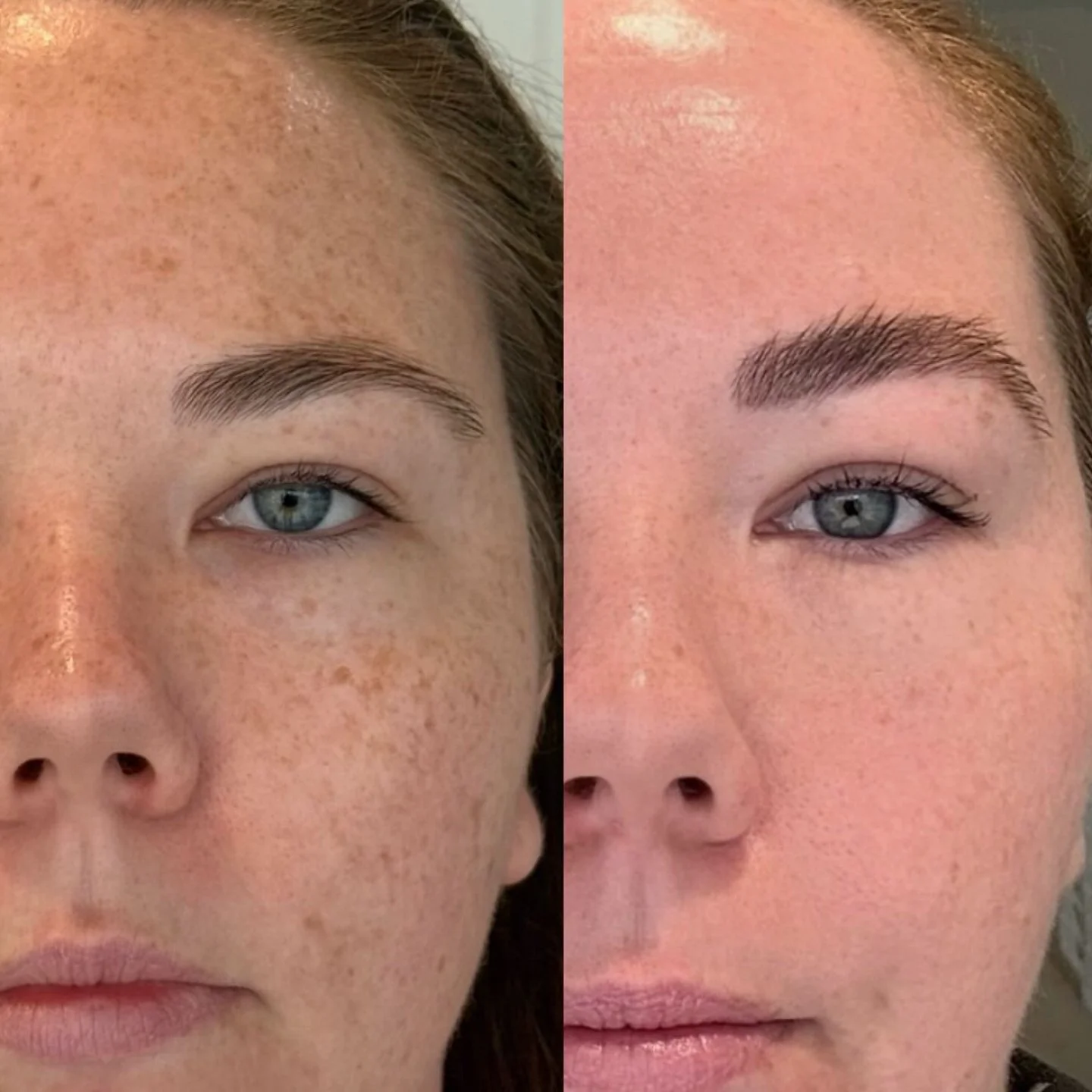 Just 1 session of BBL and Moxi combo✨
Clearer, healthier, brighter-looking skin achieved by combining two of our favourite technologies BBL and Moxi laser.

Every skin journey is different, which is why we offer complimentary consultations to assess,