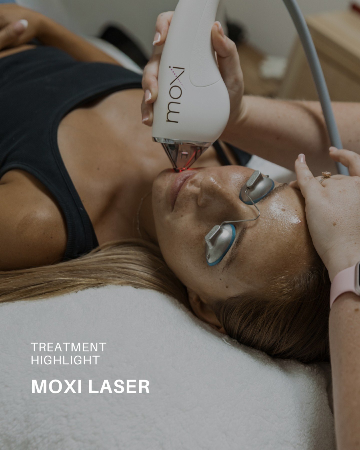 Moxi Spotlight✨

A gentle yet effective laser treatment designed to support your skin&rsquo;s natural renewal process and encourage a fresher, brighter complexion.

Moxi is ideal for those wanting to improve the appearance of pigmentation, sun damage