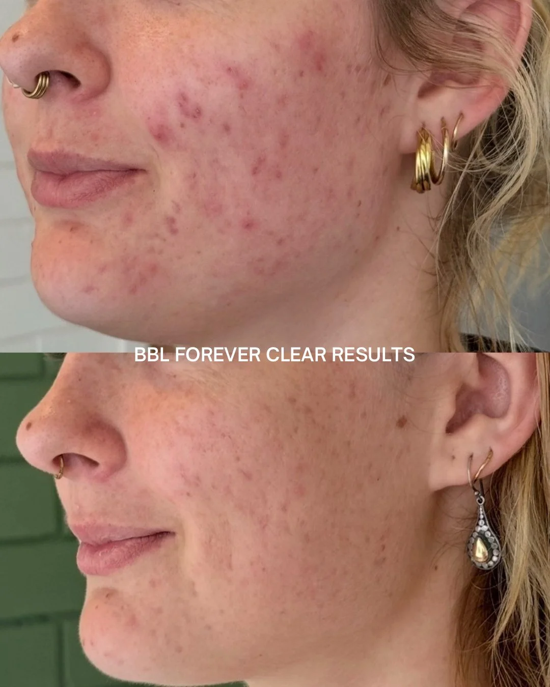 Let's talk acne..

Forever Clear BBL uses a combination of blue, yellow and infrared light to target acne-causing bacteria, reduce inflammation and support the skin&rsquo;s natural healing process.

It helps clear active breakouts while reducing post