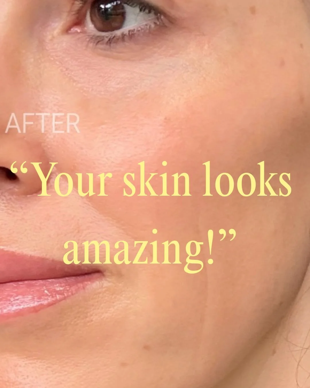 When the results are so visible that people are commenting on your skin 💁🏻&zwj;♀️

That&rsquo;s the goal.

If you&rsquo;re ready to start investing in your skin, book a skin consultation with us through the link in our bio.