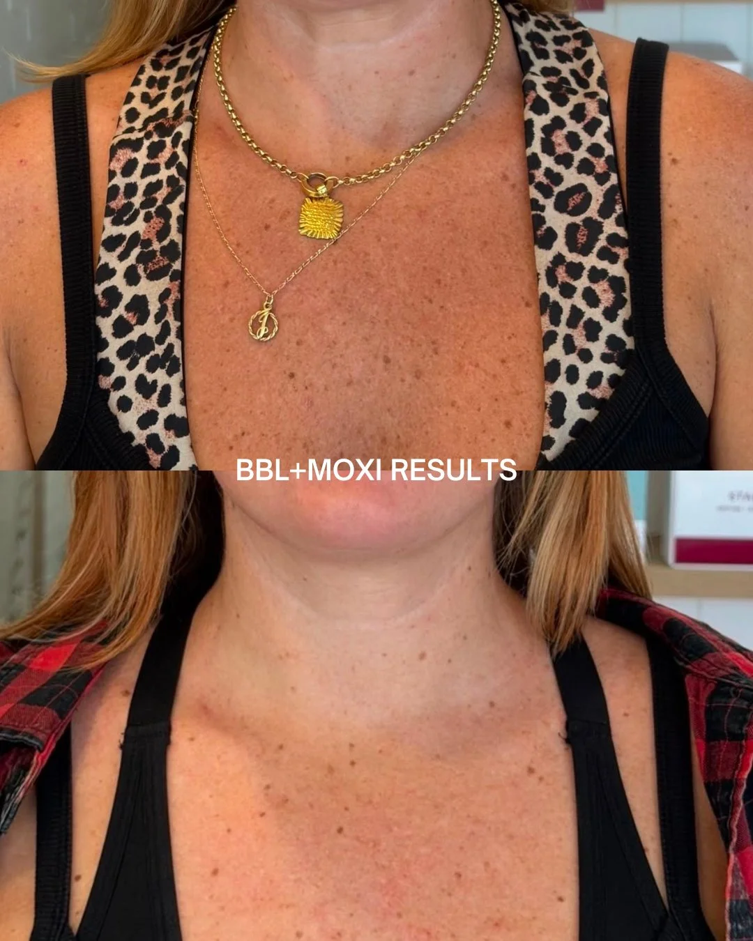 Pigmentation is our thing✨

Not all pigmentation is the same, which means not all pigmentation should be treated the same way. Melasma, sun damage, age spots, post-inflammatory pigmentation, and vascular-related concerns all require different treatme